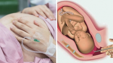 Childbirth Knowledge: Routine Rupture of Membranes