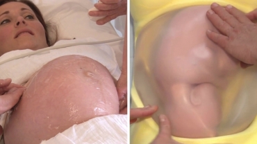External Cephalic Version (ECV) for Breech Position