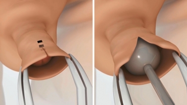Pediatric Circumcision Procedure Steps