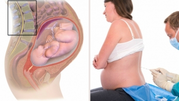 Pros and Cons of an Epidural During Labor