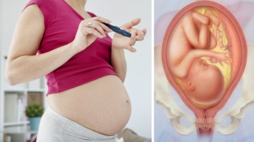 Understanding Gestational Diabetes