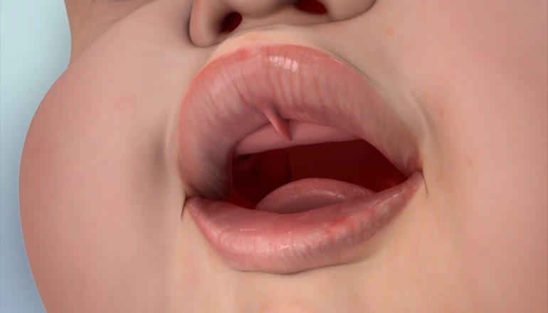Upper Lip Tie Release Treatment