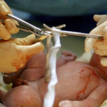 Benefits Of Delayed Cord Clamping