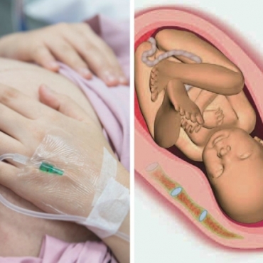 Childbirth Knowledge: Routine Rupture of Membranes