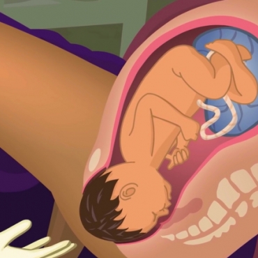 Childbirth: Steps to Vaginal Delivery