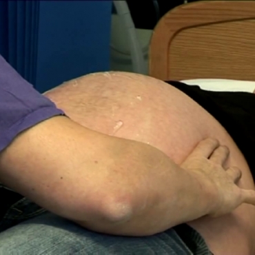 External Cephalic Version Technique for Breech Baby