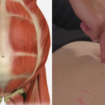 How to Do Exercise with Diastasis Recti?