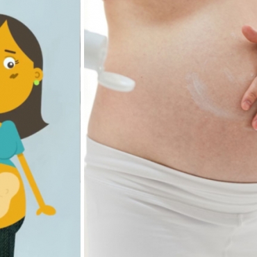 Stretch Marks During Pregnancy