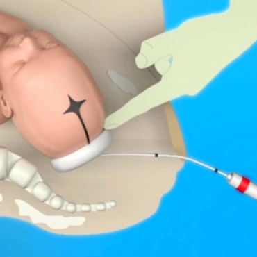 The 5 Steps of Vacuum-assisted Delivery