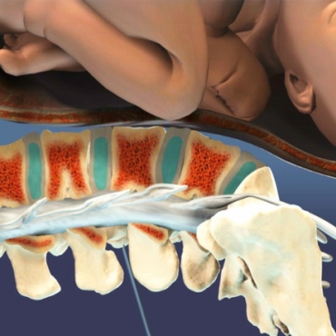 Using Epidural Anesthesia During Labor