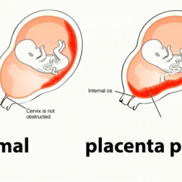 What Types of Birth Require a C-Section?