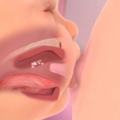 Breastfeeding Problems: Infant Factors